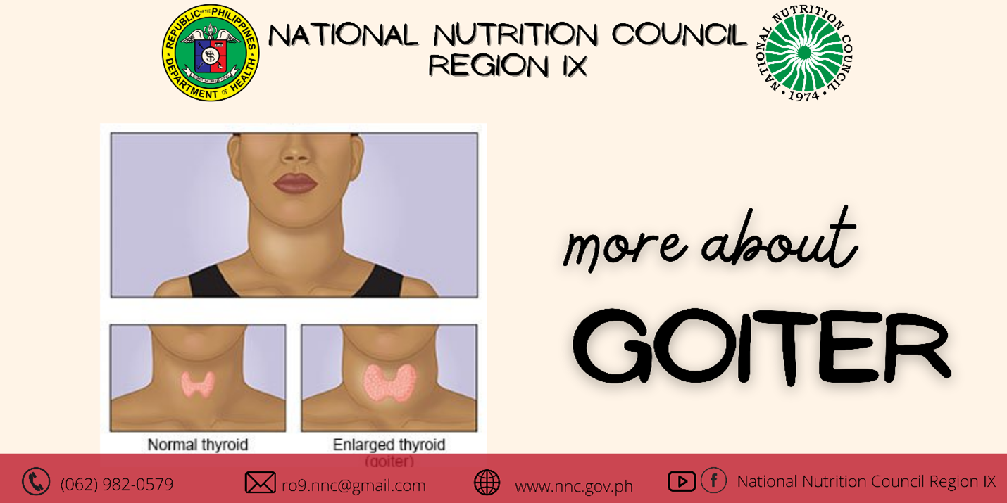 Goiter