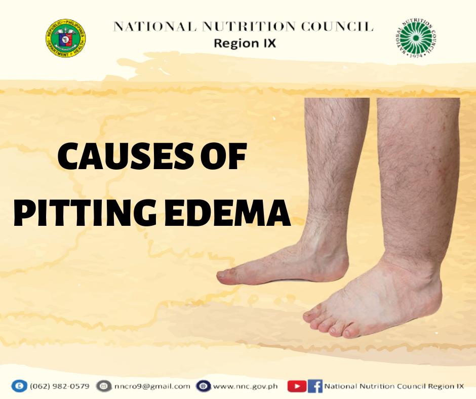 Pitting Edema