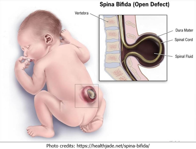 spina bifida