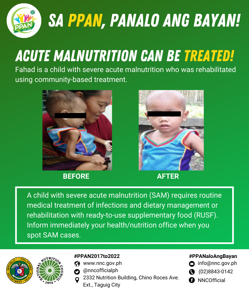 Acute Malnutrition