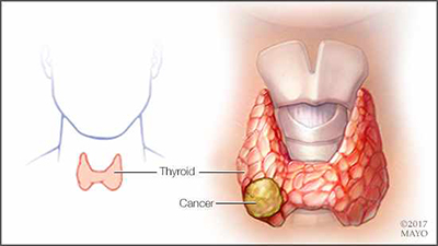 Thyroid Cancer